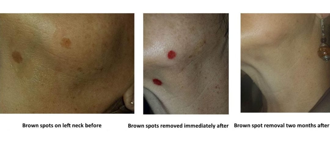 Age spot removal with microneedling