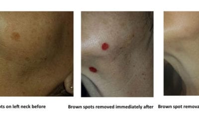 Age Spot Removal with Micro Needling Springfield MO