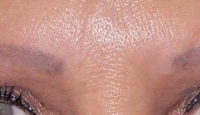Permanent Cosmetic Correction and Removal