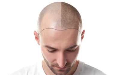 Scalp Micropigmentation (SMP)
