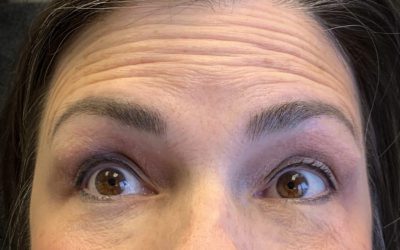 Botox™ vs. Dysport™