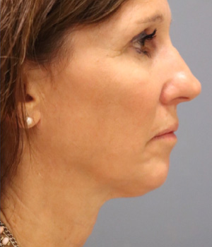 After picture of neck microneedling