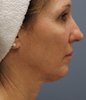 Before picture of neck microneedling