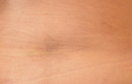 After picture of tattoo removal