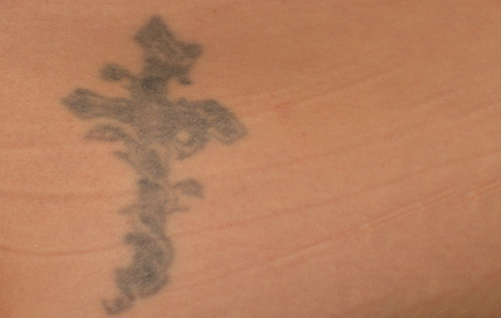Before picture of a tattoo removal
