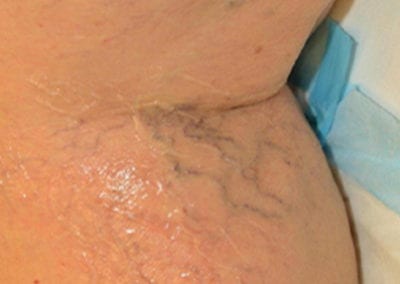 Before picture of vascular reduction