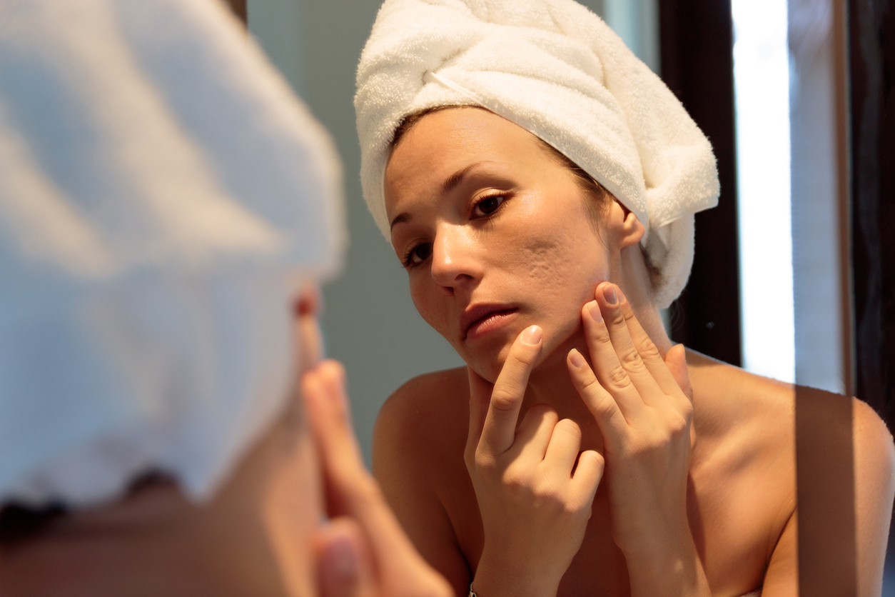 Remove acne scarring at Beautiful You Med Spa